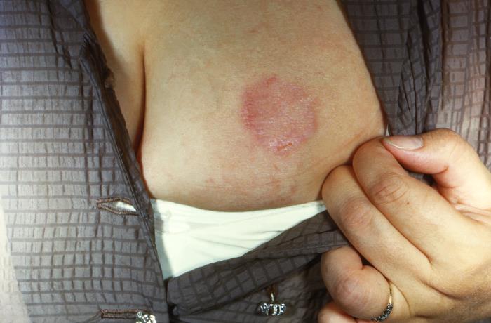 Lesión de Trichophyton mentagrophytes. CDC Public Health Image Library (PHI